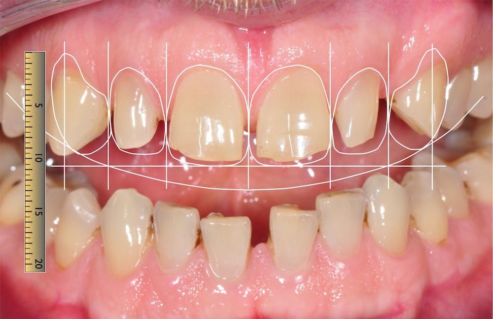 stomatologia estetyczna, stomatolog estetyczny - cyfrowe projektowanie uśmiechu