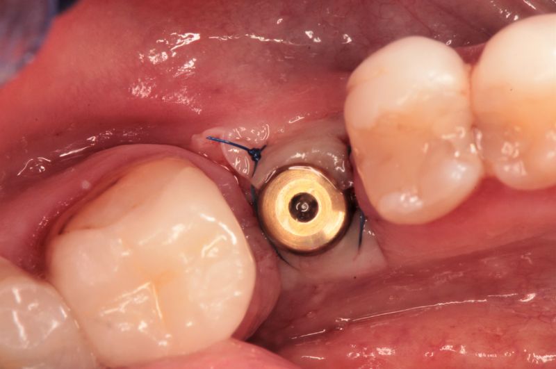 Wszczepienie Implantu Zęba Krok Po Kroku Klinika Kwiatek 7671
